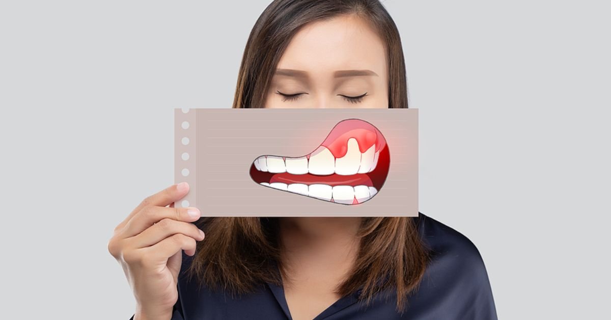 4 Stages of Gum Disease