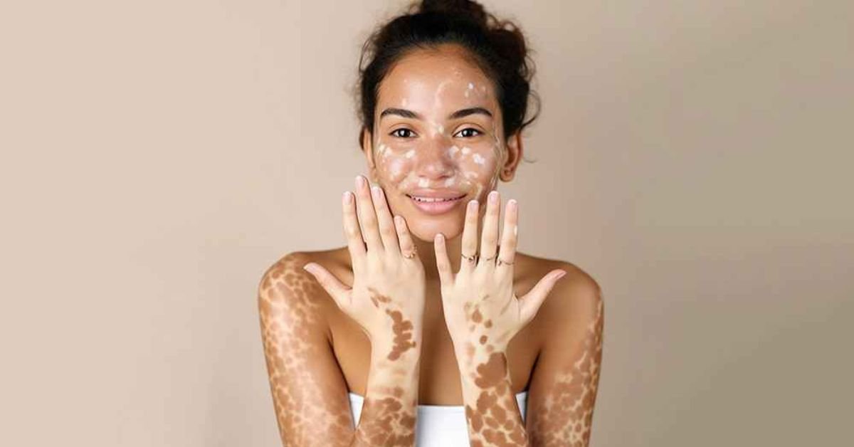 Vitiligo Treatment